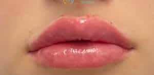 Lip Filler