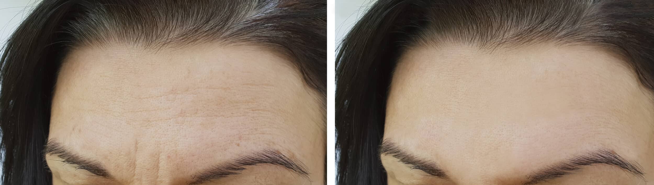 face wrinkles forehead before and after