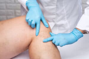 A close-up shot of a doctor examining varicose veins on a patient’s legs.